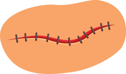 Surgical wound closing with stitches on skin surface, post operative care illustration