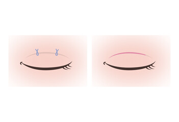 Illustration of Double Eyelid Surgery Methods (Suture and Incision Techniques)
