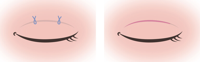 Illustration of Double Eyelid Surgery Methods (Suture and Incision Techniques)