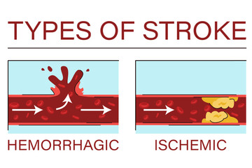 Types of brain stroke vector isolated. Ischemic and hemorrhagic stroke. Medical condition, brain injury. Blood vessel.
