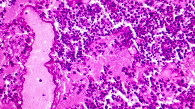 Lobar pneumonia during the hemorrhagic edema period, light microscopy displaying lung tissue inflammation with hemorrhagic changes.