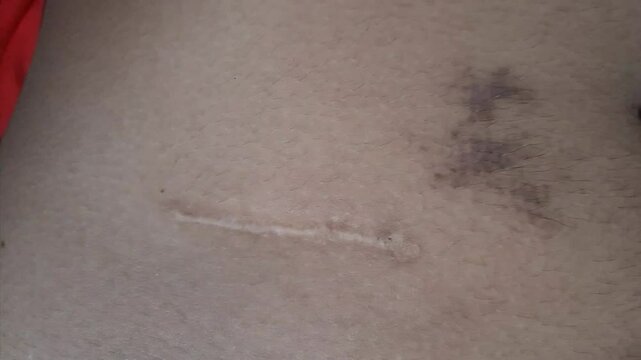 appendectomy scar, appendicitis surgery scar