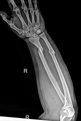 Right Forearm and Hand X‑Ray Showing Radius and Ulna Fracture for Medical Diagnosis