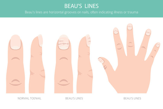 Medical infographic vector illustration of Beau's lines &ndash; horizontal nail grooves from illness or trauma
