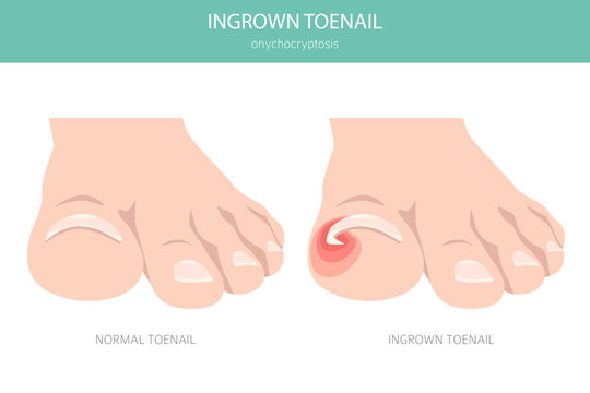 Ingrown toenail, or onychocryptosis, is a nail condition causing pain, redness, and swelling as the nail grows into the skin. Medical infographic. Vector illustration