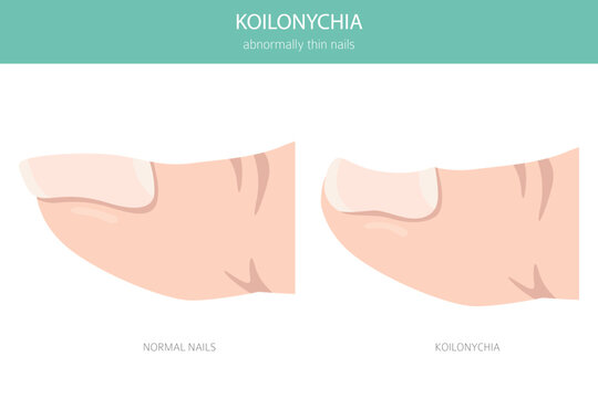 Koilonychia (Spoon Nails) &ndash; Medical Infographic Vector Illustration