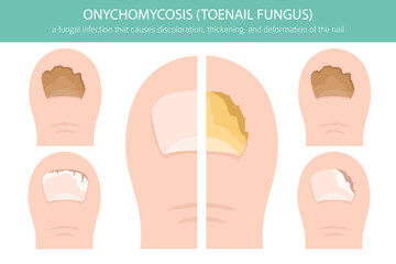 Medical vector illustration of onychomycosis – a common fungal toenail infection. Detailed infographic showing nail discoloration, thickening, and deformationh
