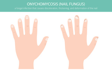 Medical vector illustration of onychomycosis – a common fungal toenail infection. Detailed infographic showing nail discoloration, thickening, and deformationh