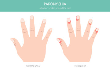 Paronychia is an infection of the nail fold causing redness, swelling, and pain. Often linked to bacteria, trauma, or moisture exposure. Medical infographic design. Vector illustration