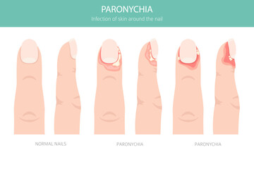 Paronychia is an infection of the nail fold causing redness, swelling, and pain. Often linked to bacteria, trauma, or moisture exposure. Medical infographic design. Vector illustration