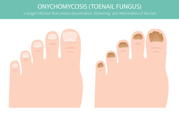 Medical vector illustration of onychomycosis – a common fungal toenail infection. Detailed infographic showing nail discoloration, thickening, and deformationh