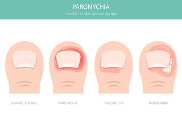Paronychia is an infection of the nail fold causing redness, swelling, and pain. Often linked to bacteria, trauma, or moisture exposure. Medical infographic design. Vector illustration
