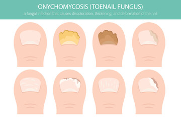 Medical vector illustration of onychomycosis – a common fungal toenail infection. Detailed infographic showing nail discoloration, thickening, and deformationh