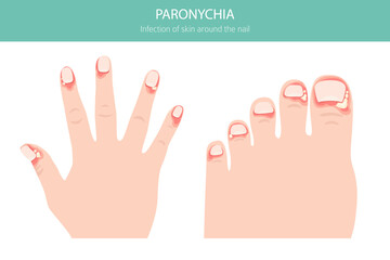 Paronychia is an infection of the nail fold causing redness, swelling, and pain. Often linked to bacteria, trauma, or moisture exposure. Medical infographic design. Vector illustration