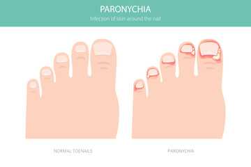 Paronychia is an infection of the nail fold causing redness, swelling, and pain. Often linked to bacteria, trauma, or moisture exposure. Medical infographic design. Vector illustration