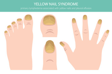 Yellow Nail Syndrome is a rare condition marked by thick, slow-growing yellow nails, often with lymphedema and respiratory issues. Medical infographic. Vector illustration