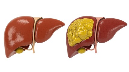 Comparison of a healthy liver and a liver with steatosis exhibiting yellow deposits on it