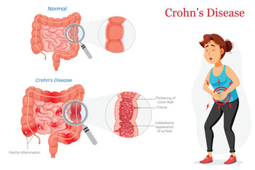 Healthy vs Crohns Intestine Diagram Showing Abdominal Pain