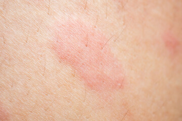 Fototapeta premium Skin allergy rash dermatitis texture close up background