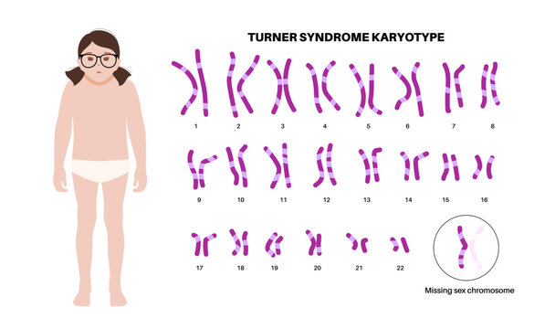 Turner syndrome poster