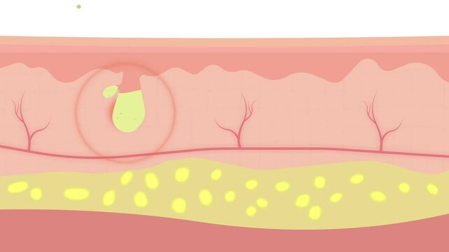 acne spot formation on skin with oil sebum fill clogged pore