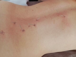 Fototapeta premium Close up of acupuncture needles inserted into a womans bare back during traditional Chinese medicine session for pain treatment.