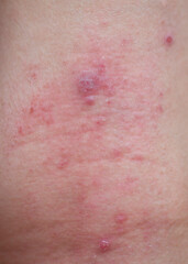 Close-up of red spots on the skin of a woman.