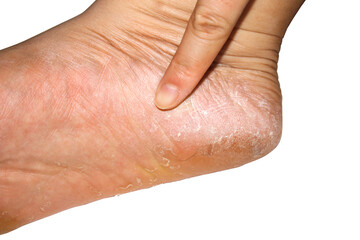 Detailed Close-Up of Dry Skin on Heal with Finger Pointing to Flake