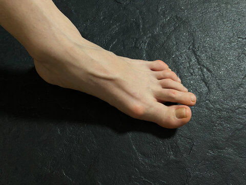 Bunion on woman's foot. Hallux Valgus or foot deformities. Osteoarthritis of the first metatarsophalangeal joint. Deformities of adjacent toes. Hammer toe