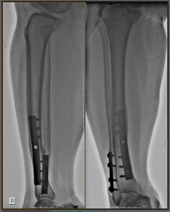 X-ray metal in conventional radiological examination of the cruris or tibia fibula bones