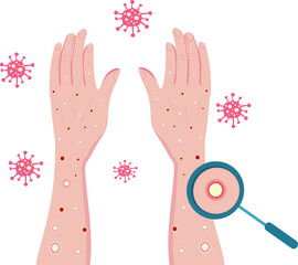 Monkeypox Rash on Arms and Face – Infectious Disease Concept