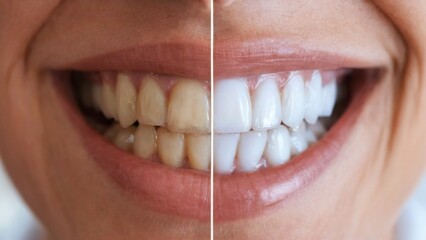 Teeth Whitening Transformation: Closeup showing natural vs. whitened teeth with healthy, cavityfree appearance. Focus on perfect white smile.