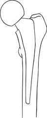 vector illustration of hip after hemiarthroplasty bipolar