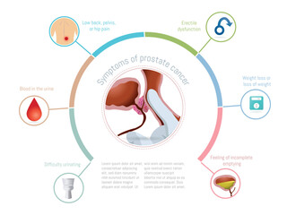 Recognizing prostate cancer symptoms, a medical illustration