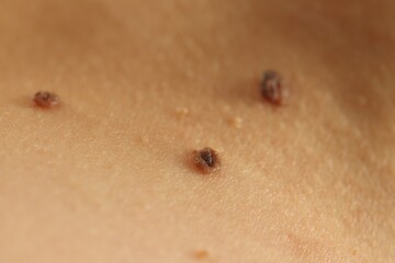 Woman with moles on her skin, closeup