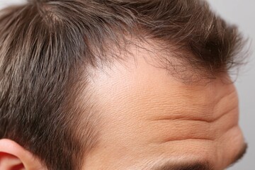Obraz premium Close-up of man's forehead showing receding hairline, thinning hair and visible skin.