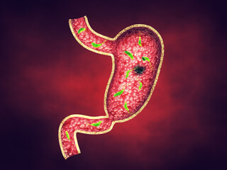 Peptic ulcers are usually caused by an infection of Helicobacter pylori (H. pylori) bacteria. They are open sores on the inner lining of the stomach and the upper part of the small intestine