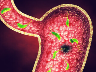 Peptic ulcers are usually caused by an infection of Helicobacter pylori (H. pylori) bacteria. They are open sores on the inner lining of the stomach and the upper part of the small intestine