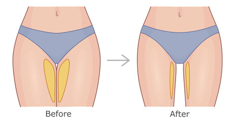 Women's thighs in panties before and after weight loss. Slimming of inner thighs vector illustration.