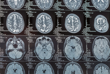 Magnetic resonance imaging or MRI image of the brain