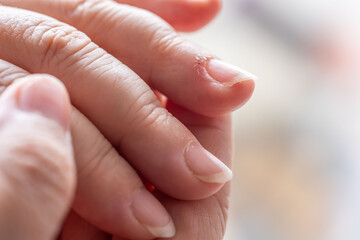 hangnails on fingers, skin scrap, area of ​​exfoliated epidermis surrounding nail, Compulsive nail and cuticle biting, Stress relief or self-harm, obsessive-compulsive disorder, mental health