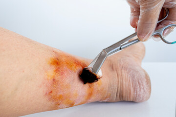 doctor's hands smearing medicine on damaged skin on female limb, chronic dermatitis, wound on...