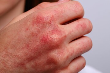Fototapeta premium Skin condition and eczema symptoms on hand for dermatology awareness