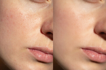 Side-by-side comparison of facial skin before and after skincare treatment. Visible improvement in texture, pore reduction, and smoothness in natural light.