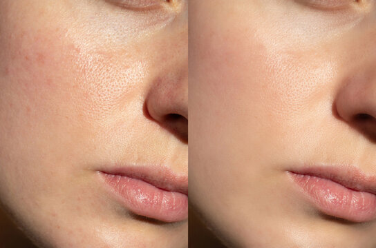 Side-by-side comparison of facial skin before and after skincare treatment. Visible improvement in texture, pore reduction, and smoothness in natural light.