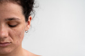 Fototapeta premium Close-up skin texture with red pimples, irritation and clogged pores, which indicates dermatological problems with skin care. Hormonal acne and spots on the face.