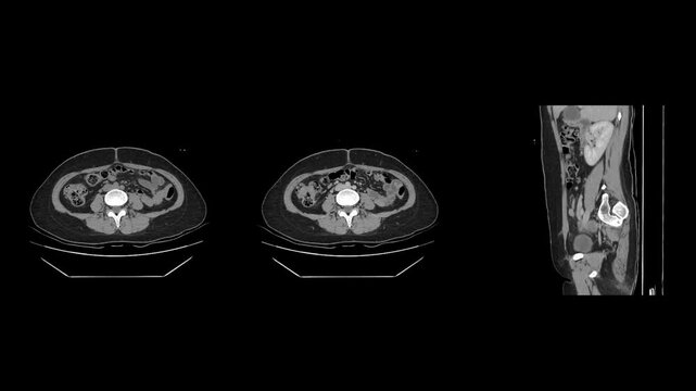 Ct scan analysis for appendicitis and gallstones in patients radiology room medical imaging clinical viewpoint