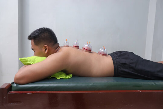Asian male lying down as a therapist performs cupping therapy, with several cups placed on his back. Traditional treatment for muscle relief, relaxation, and improved circulation