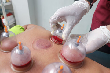 Asian male lying down as a therapist performs cupping therapy, with several cups placed on his...