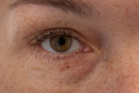 Close-up of woman&rsquo;s eye showing dark circles and skin texture